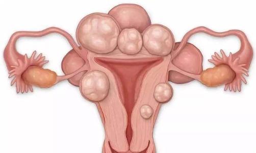 子宫腺肌症能做广州试管婴儿吗?